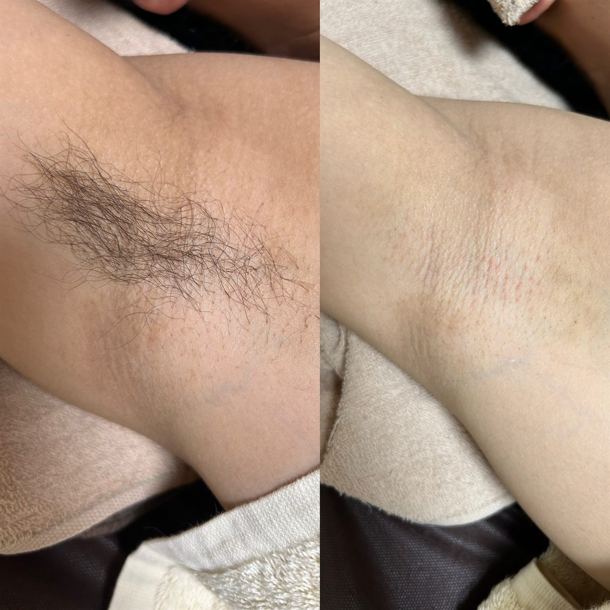 ワキのワックス脱毛の施術前後の比較写真。左が施術前、右が施術後