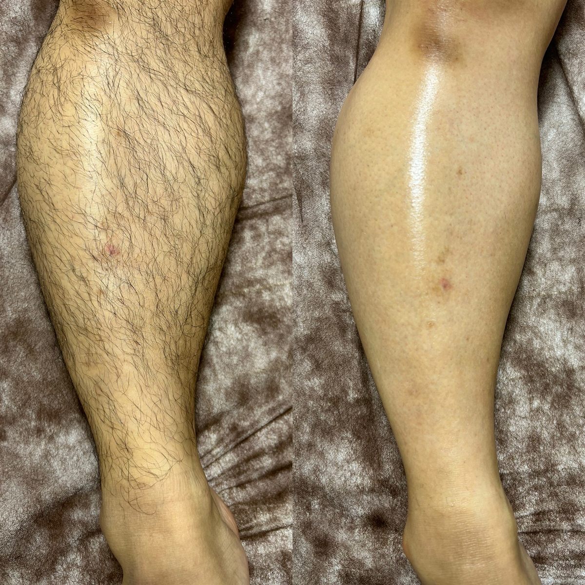 膝下のワックス脱毛の施術前後の比較写真。左が施術前、右が施術後