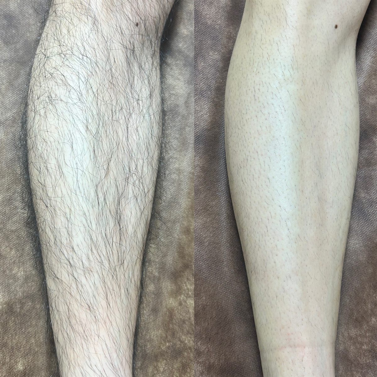 膝下の光脱毛の施術前後の比較写真。左が施術前、右が光照射1回後